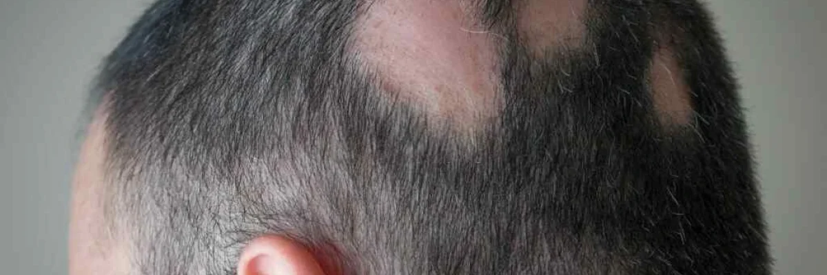 Alopecia-Treatment