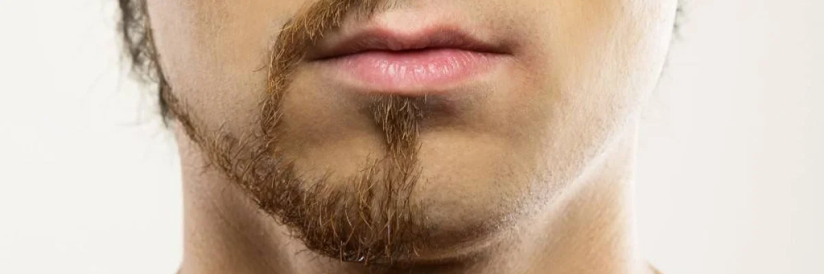 Beard-Transplant